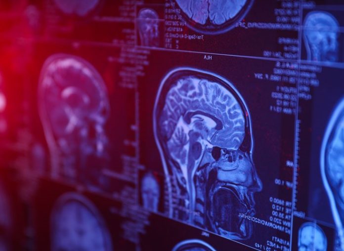 drug shows promise for stroke patients who miss the current medical treatment window