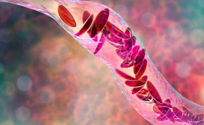 US FDA approves Vertex's gene therapy for sickle cell disease in children as young as two