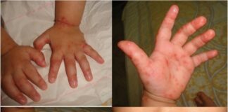 ممنوعیت حضور دانشآموزان در مدارس در صورت ابتلا به HFMD