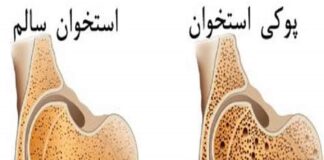 کدام استخوانها مستعد بروز شکستگی هستند؟