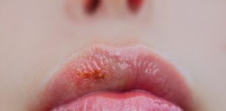 چگونه تبخال را سریع درمان کنیم؟