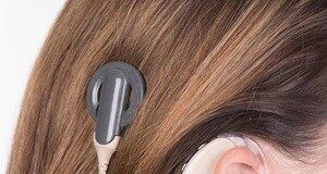 کاشت حلزون شنوایی رایگان شد