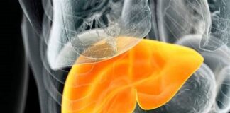 افزایش کبد چرب در ایرانیان