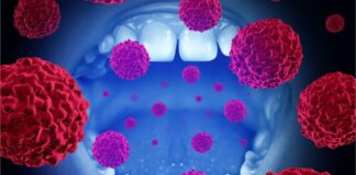 ۶ علامت ابتلا به سرطان دهان