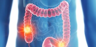 سرطان روده بزرگ؛ سومین علت مرگومیرها