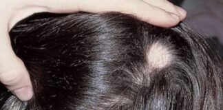 نکاتی درباره ریزش موی سکهای