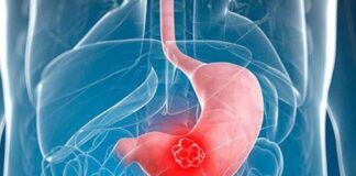 جنسیت و سن در بقای بیماران مبتلا به سرطان معده نقش دارد