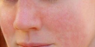 لوپوس چیست؟ علائم و راهکارهای درمانی