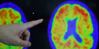 ژن APOE۴ چیست و چه ارتباطی با بیماری آلزایمر دارد؟