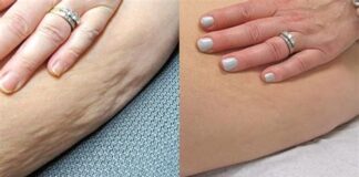 چند راهکار طبیعی برای کمک به کاهش ظاهر سلولیت