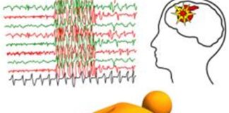 علل بروز بیماری صرع