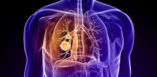 دستگاه آزمایشی Optune به افزایش بقای مبتلایان به نوعی سرطان ریه کمک کرد