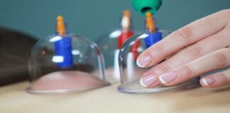 تاثیر حجامت در بهبود میگرن