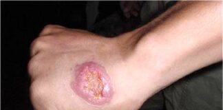 سالک، بیماری آندمیک ۱۹ استان کشور