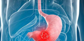 روند افزایشی سرطان معده در زنان میانسال