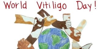 ۲۵ ژوئن؛ روز جهانی بیماری ویتیلیگو