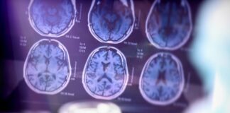 آزمایش AD-Detect خطر ابتلا به آلزایمر را تشخیص میدهد