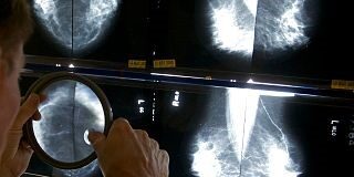 زنان ۷۰ سال به بالا در معرض خطر تشخیص اشتباهی سرطان پستان