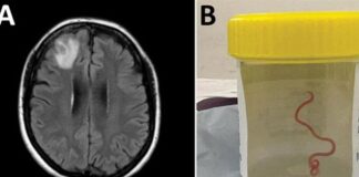 کرم انگلی در مغز یک زن کشف شد