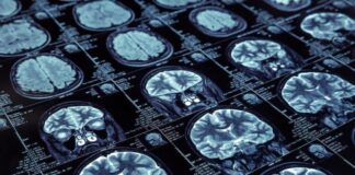 داروهای آلزایمر جدید ممکن است برای سفیدپوستان مفیدتر از سیاهپوستان باشد