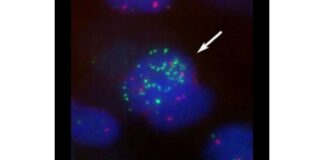 کارآزمایی بالینی: ترکیبی از داروهای ایمنیدرمانی به افزایش طول عمر بیماران مبتلا به ملانوم متاستاز کمک میکند