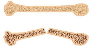 غربالگری رایگان پوکی استخوان برای زنان ۵۰ سال به بالا