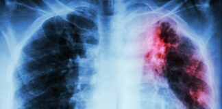 بریتانیا/ افزایش موارد ابتلا به سل و توقف پیشرفت در مبارزه با این بیماری