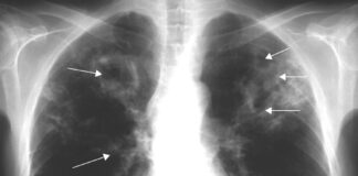 در صورت سرفه بیش از دو هفته به مراکز بهداشتی مراجعه کنید