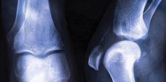 افزایش پوکی استخوان با مصرف نوشابههای گازدار