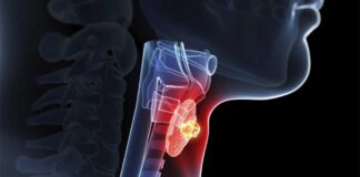 افزایش آمارهای سرطان تیروئید در بین زنان پس از شیوع کووید