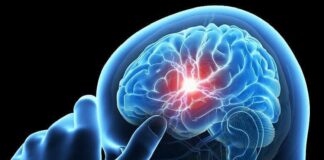 سکته مغزی دومین علت مرگ در ایران