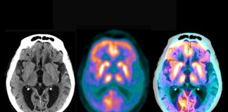 بازگشت مجدد به ساخت واکسنهای آلزایمر