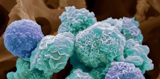 بروز سالانه تا ۹۰۰۰۰ مورد جدید سرطان در ایران