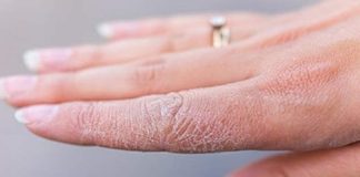 نشانههای تغذیه نامناسب با ۶ عارضه پوستی