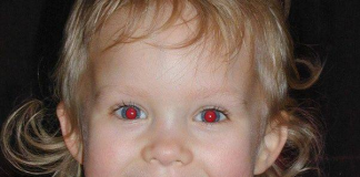 قرمزی مردمک چشم در عکسها نشانه بیماری است؟