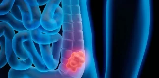 سن غربالگری سرطان روده بزرگ