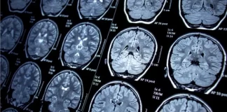 عملکرد موفق داروی آزمایشی tavapadon در بهبود علائم پارکینسون