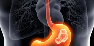 تایید داروی Vyloy در بریتانیا برای درمان نوعی سرطان معده