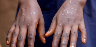 گزارش حدود ۳۰ هزار مورد مشکوک به mpox در سال ۲۰۲۴