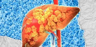 بررسی داروی آزمایشی کاهش وزن survodutide برای درمان نوعی بیماری کبد چرب