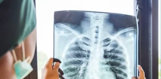 درمان رایگان سل در شبکه بهداشتی درمانی
