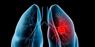 اجرای طرح ملی پایش گاز رادون در ساختمانهای مسکونی کشور | گاز رادون دومین عامل ابتلا به سرطان ریه