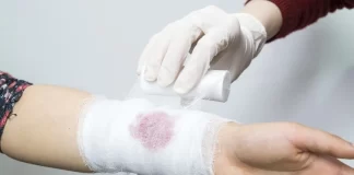 توصیههای خودمراقبتی در مواقع سوختگی و زمان مراجعه به مراکز بهداشتی درمانی