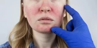 داروی Emrosi برای بیماری روزاسه مورد تایید قرار گرفت