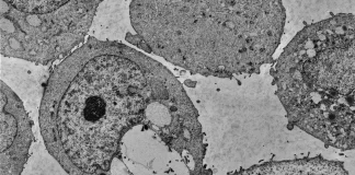 هر ۴ هفته تاخیر در شناسایی سرطان تا ۲۰ درصد میزان مرگومیر را افزایش میدهد