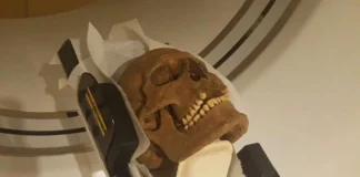 وایکینگها فقط با دشمنان نجنگیدند: اسکن جمجمههای باستانی بیماریهای دندانی و عفونتهای گسترده را نشان میدهد