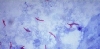 واکسیناسیون بثژ در نوزادان و غربالگری راه پیشگیری از شیوع سل