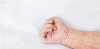 افزایش موارد ابتلا به سرخک در ایران