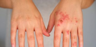 موفقیت داروی آزمایشی شرکت نکتار در درمان اگزما