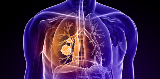 نقش محوری سیگار و قلیان در افزایش ابتلا به سرطان ریه